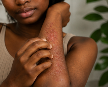 Eczema Treatment for Black Skin