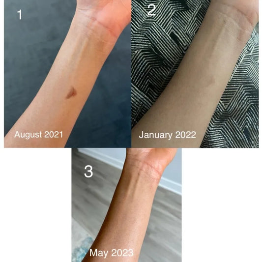 How Does Shea Butter Remove Scars From Skin?